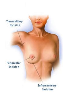 Breast augmentation