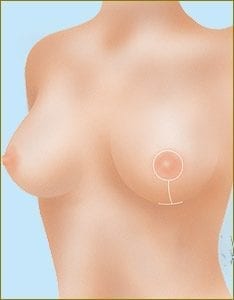 Methods of breast reduction