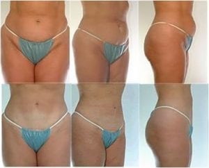 Abdominoplasty