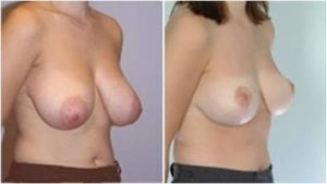 Breast reduction