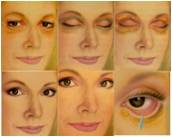 Blepharoplasty